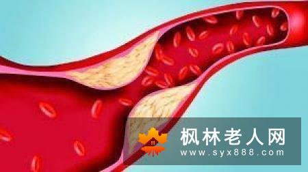 老人注意：运动时颈部活动太剧烈或引起脑中风！
