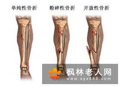 中年健身注意啥？ 骨科医生亲自告诉你