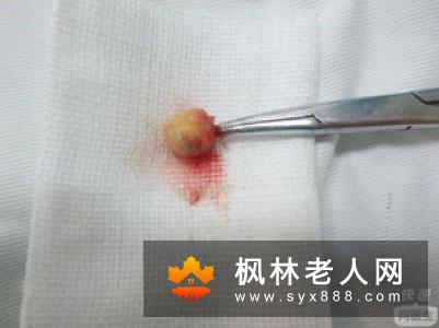 阴囊皮脂腺囊肿 手术治疗最佳
