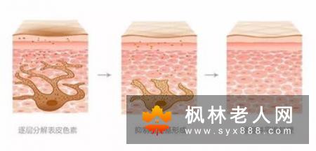 要去老年斑有绝招