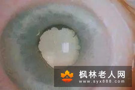 白内障？不用怕！