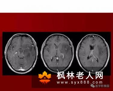 头痛,偏头痛的其他诱因