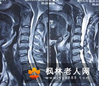 三叉神经营养性损害有哪些表现及如何诊断？