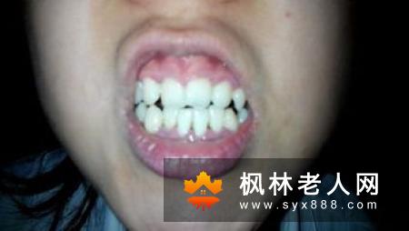 牙周病是神马？都有哪些症状呢？