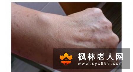 怎样预防长老年斑 老年人可从四方面做好准备