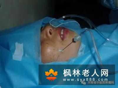 射频治疗三叉神经痛的注意事项