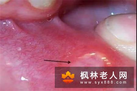 得了口腔溃疡后吃什么比较好