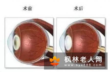 得了白内障应该去什么医院治疗呢