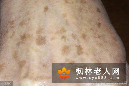 吃什么能预防老年斑 这些食物不可少
