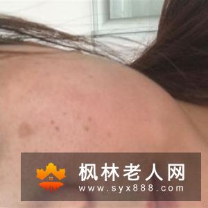 如何治疗老年斑 结合食疗法更有效