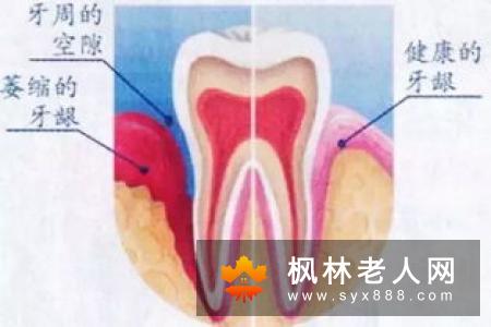 牙齿萎缩能否种植牙？老人牙不好该怎么办
