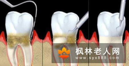 牙周病要怎么治疗