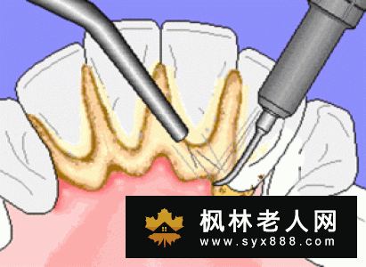 为什么会有牙龈炎?