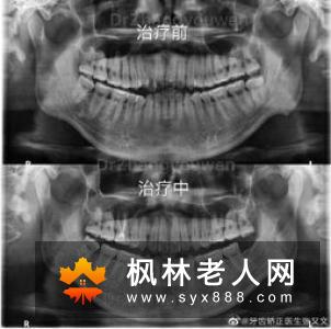 为什么会有牙龈炎?