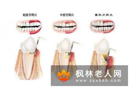 为什么儿童易得牙周病?