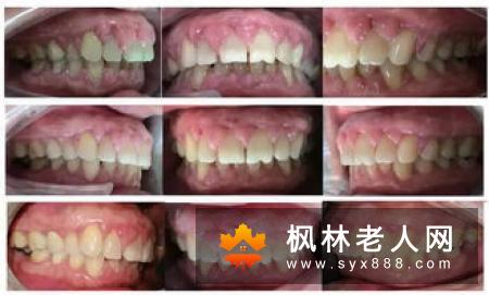 牙周炎该如何防治
