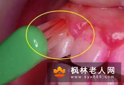 牙周病有哪些危害如何治疗