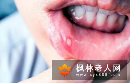 你对口腔溃疡了解多少