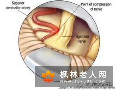 延髓空洞症与三叉神经痛的区别