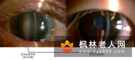 白内障？不用怕！