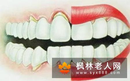 牙周病患者的正畸治疗