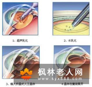目前白内障的治疗方法有哪些