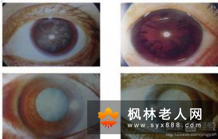 先天性白内障的诊治方法