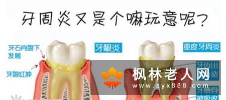 成年人的牙周炎表现是怎样的？