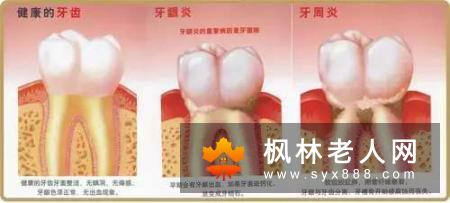 牙周病要怎么治疗