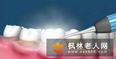 牙周病是可以预防的疾病
