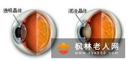 早期白内障调理要点